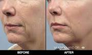 Rf Microneedling Before And After
